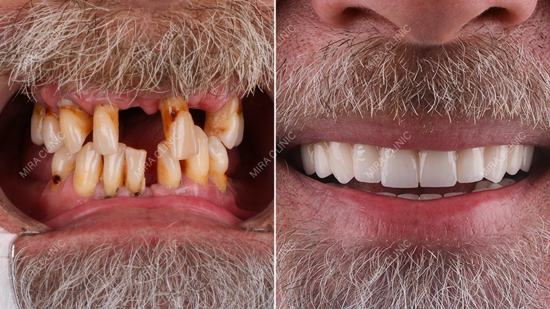 Before and After Real Veneers Result